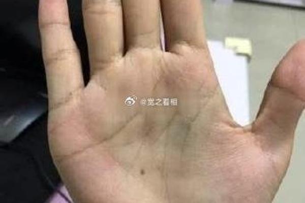 手相痣的不同位置象征着什么