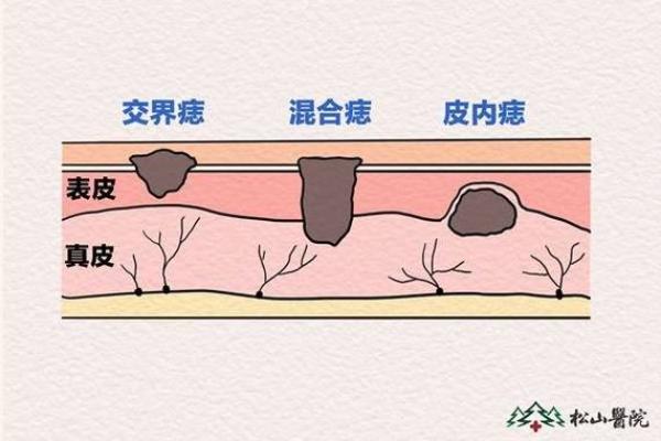 如何识别与恶痣相关的危险信号及预防措施