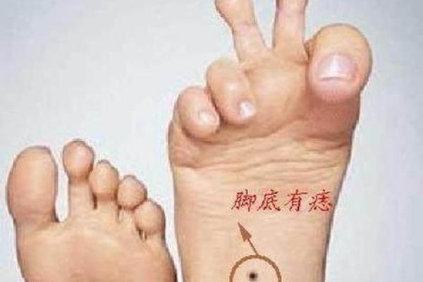 脚底痣相解读，看透你的财运、健康与运势！