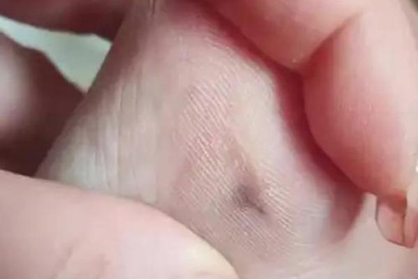脚趾尖上的秘密符号：脚趾痣的神奇解读