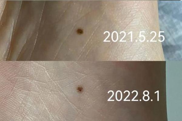 脚底有痣是福是祸？一探究竟，痣相解析让你财运亨通！