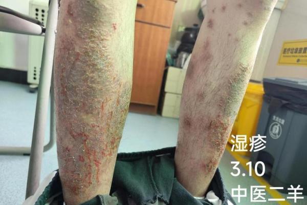 湿疹患者福音！家居风水布置，轻松改善症状