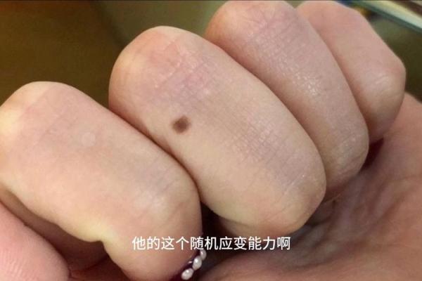 手背痣相学大揭秘:右手背痣的惊人意义! 手背痣相学大揭秘:右手背痣的惊人意义!