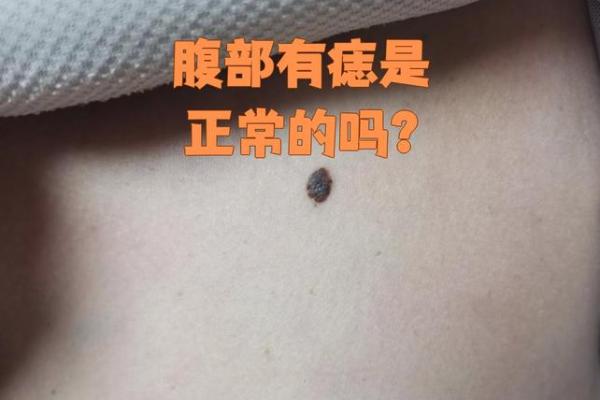 命理解码:女人肚痣预示着什么好运? 命理解码:女人肚痣预示着什么好运?