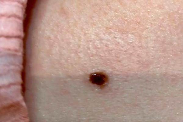 背后痣:男人魅力加分项? 背后痣:男人魅力加分项?